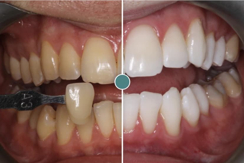 Teeth Whitening.